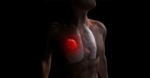 A tüdőrák 8 figyelmeztető jele, amit nem szabad figyelmen kívül hagyni