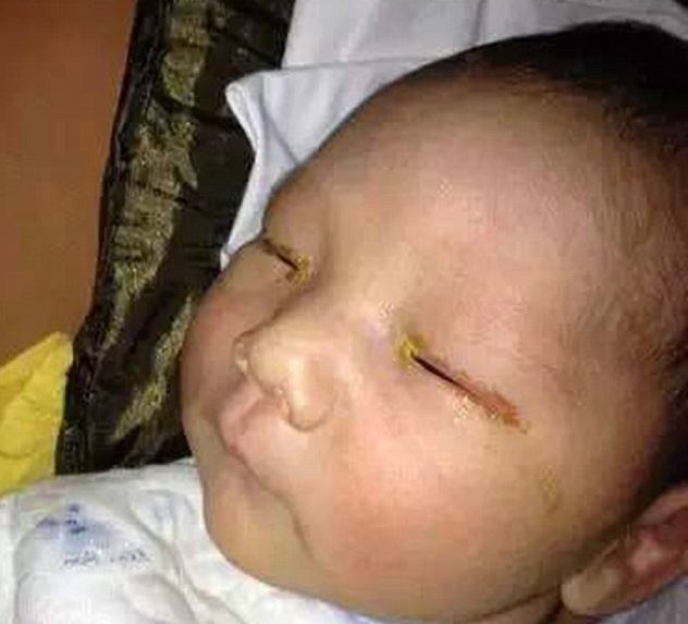 Megvakult az újszülött, miután belevakuztak a szemébe