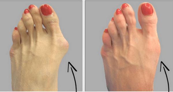 Why-do-doctors-keep-this-simple-recipe-away-from-the-public-Here’s-how-to-get-rid-of-bunions-completely-natural