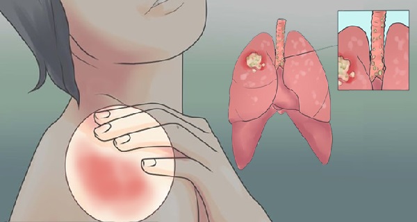 20-EARLY-WARNING-SIGNS-OF-LUNG-CANCER-THAT-WOMEN-SHOULD-NEVER-IGNORE