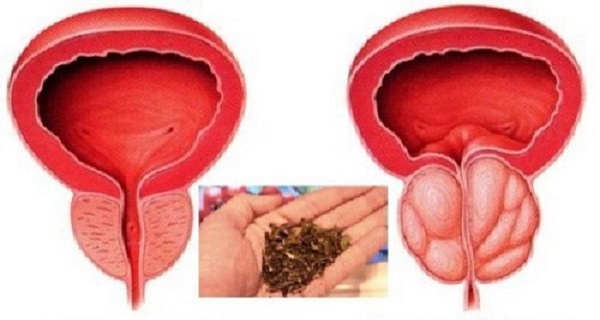 this-is-the-best-natural-remedy-for-enlarged-prostate