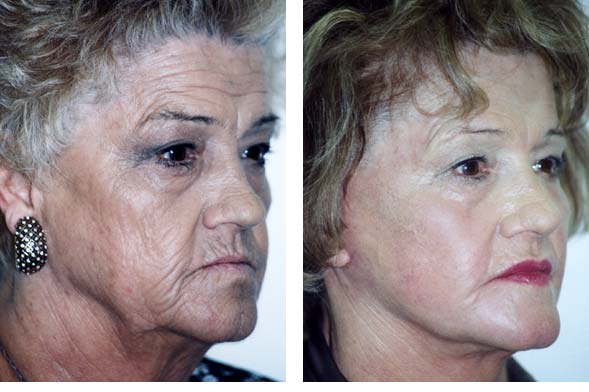 laser-treatment-for-face-wrinkles-before-and-after-picture
